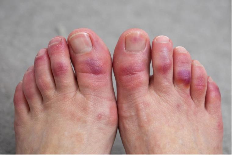 Lesiones por sabañones en los pies